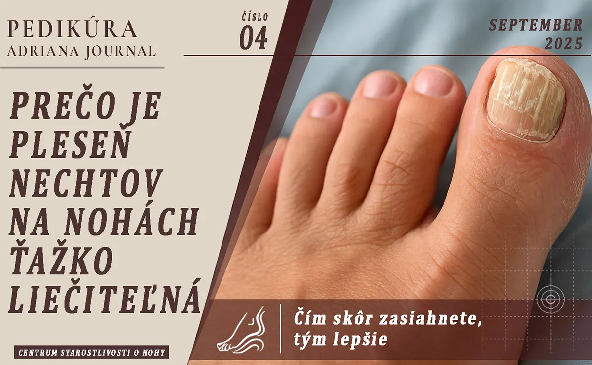 Prečo je pleseň nechtov na nohách ťažko liečiteľná