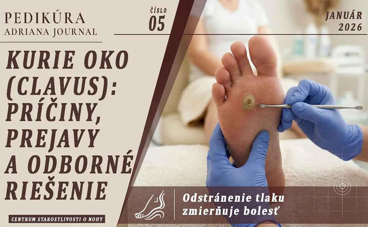 Kurie oko (clavus): príčiny, prejavy a odborné riešenie