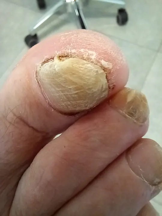 Necht nadvihnutý nánosom pod platničkou