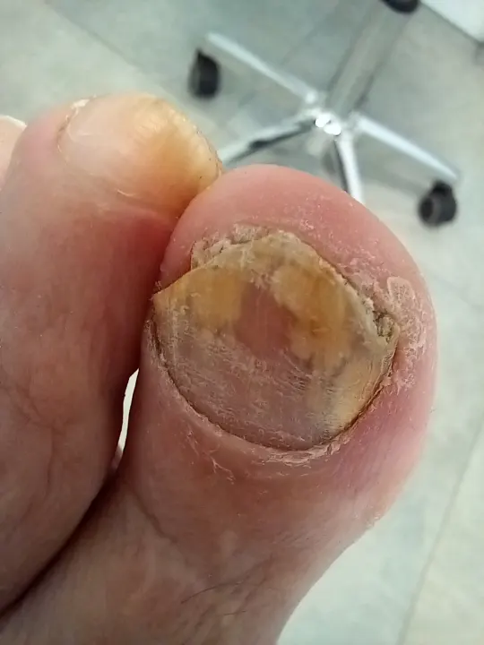Necht nadvihnutý nánosom pod platničkou