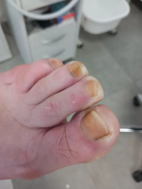 Keď dlhé nechty začnú tlačiť na končeky prstov