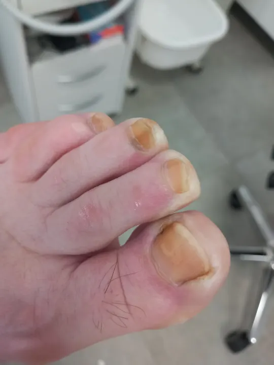 Keď dlhé nechty začnú tlačiť na končeky prstov