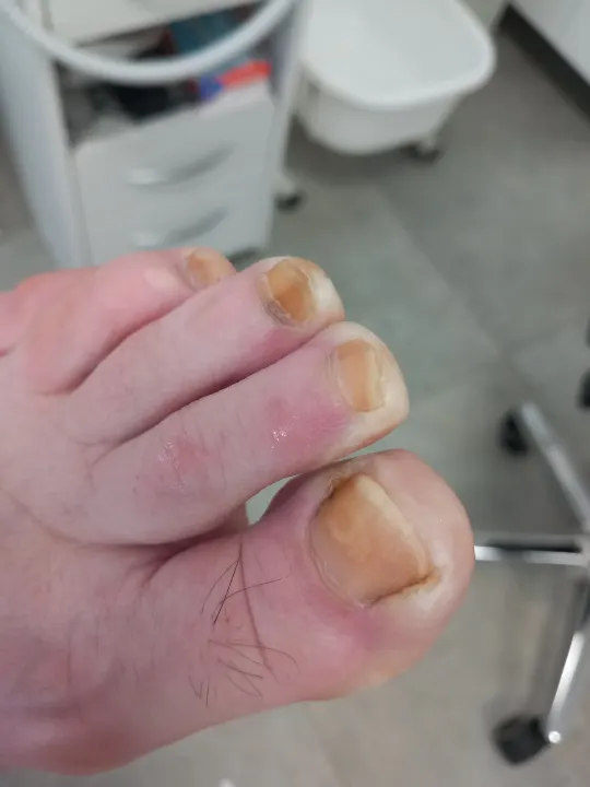 Keď dlhé nechty začnú tlačiť na končeky prstov