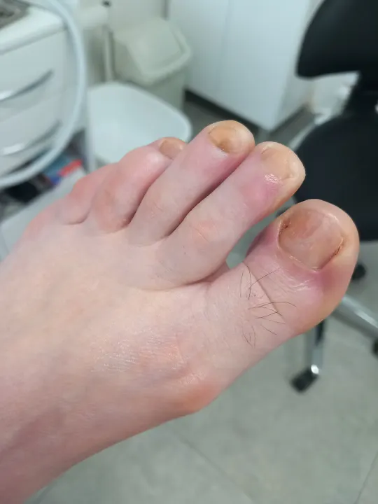 Keď dlhé nechty začnú tlačiť na končeky prstov