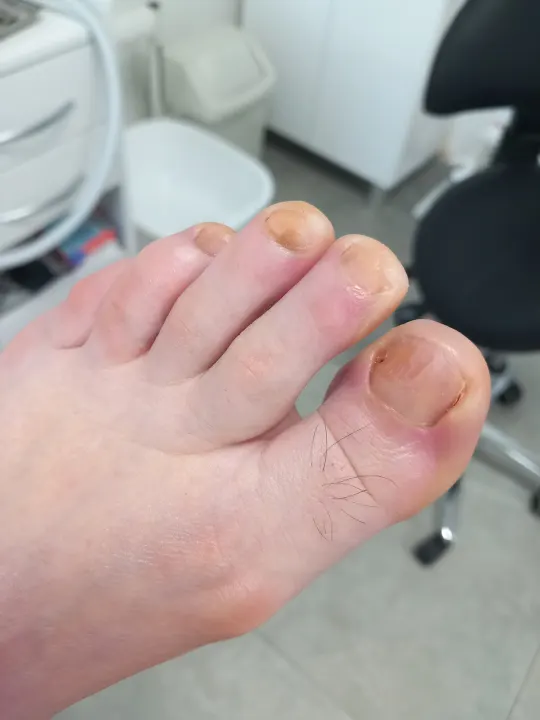 Keď dlhé nechty začnú tlačiť na končeky prstov