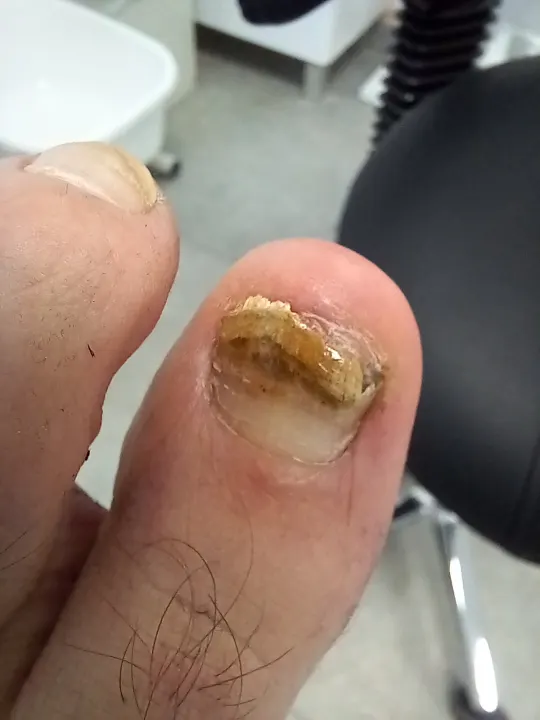 Silno poškodený necht oddelený od lôžka