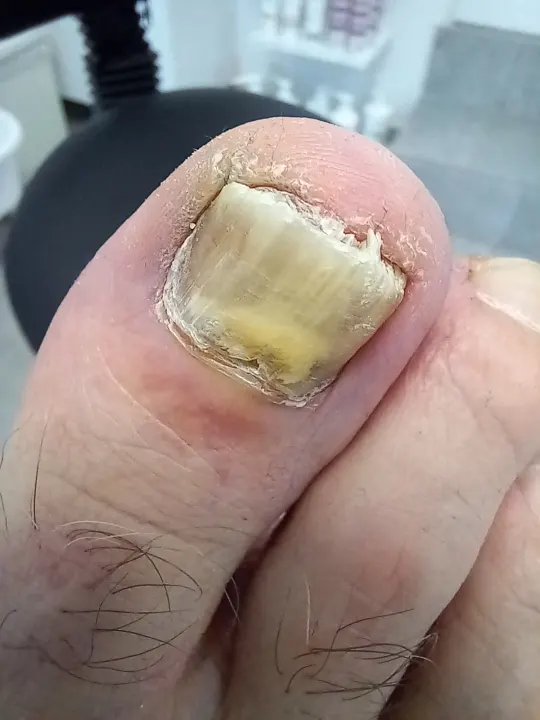 Silno poškodený necht oddelený od lôžka