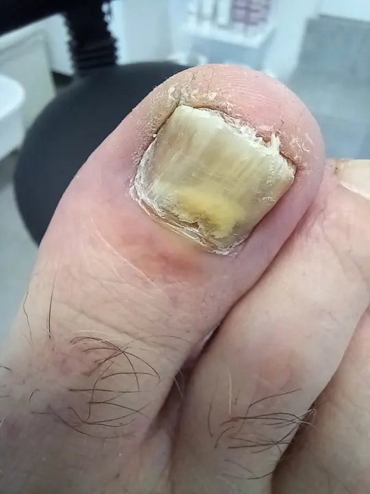 Silno poškodený necht oddelený od lôžka