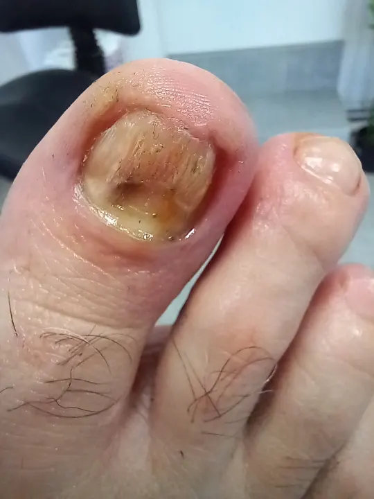 Silno poškodený necht oddelený od lôžka