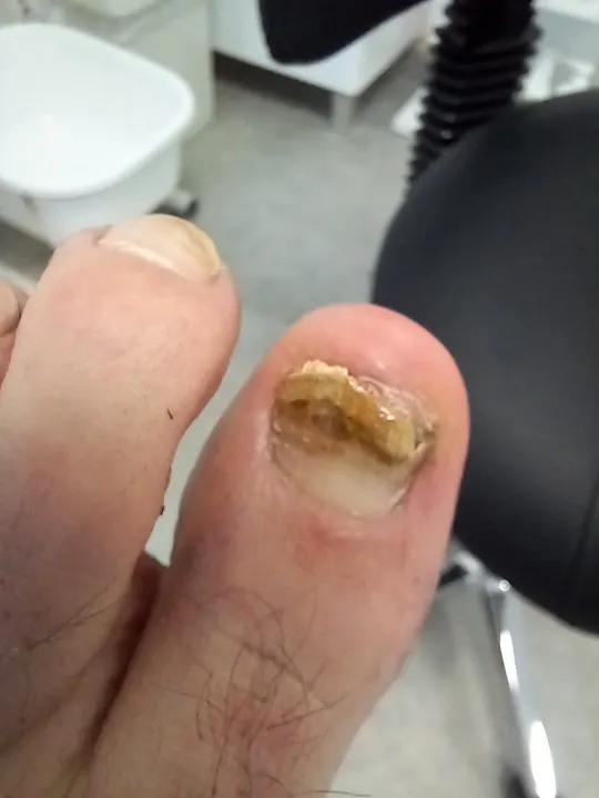 Silno poškodený necht oddelený od lôžka