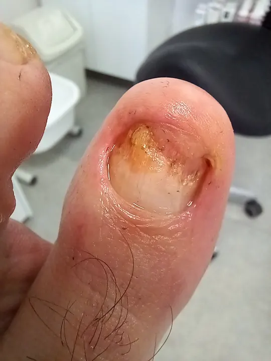 Silno poškodený necht oddelený od lôžka