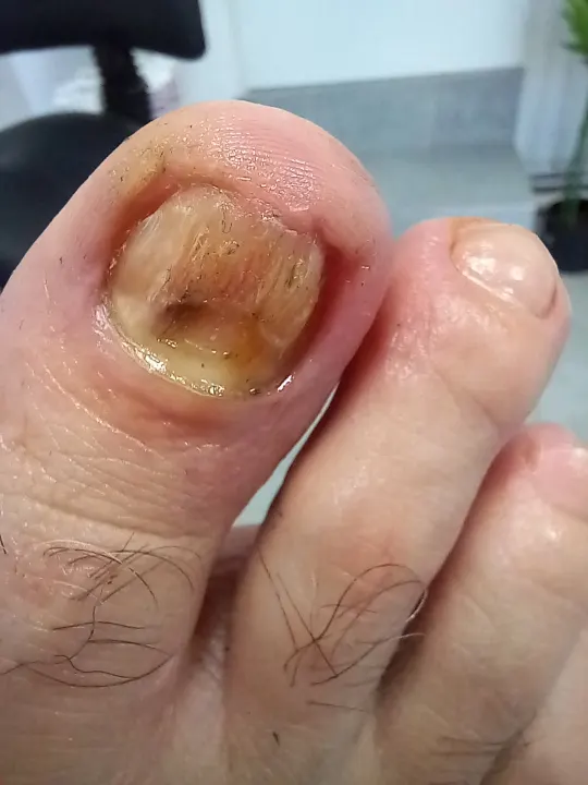 Silno poškodený necht oddelený od lôžka