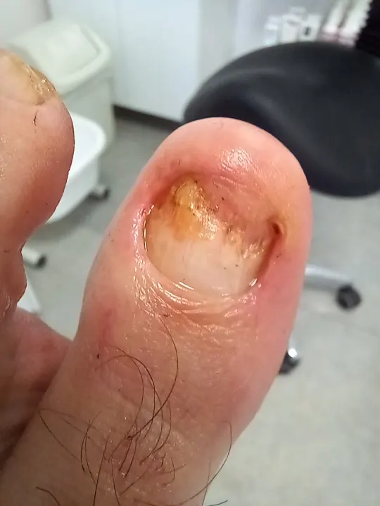 Silno poškodený necht oddelený od lôžka