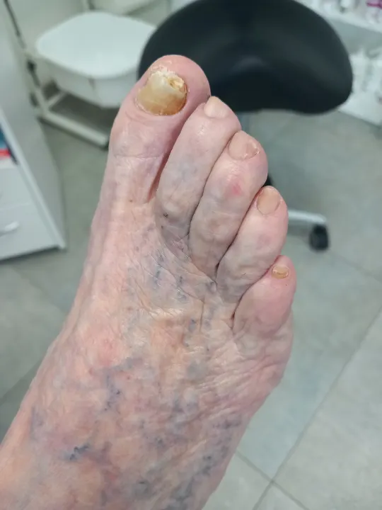 Zhrubnutý necht palca s uvoľnenou platničkou