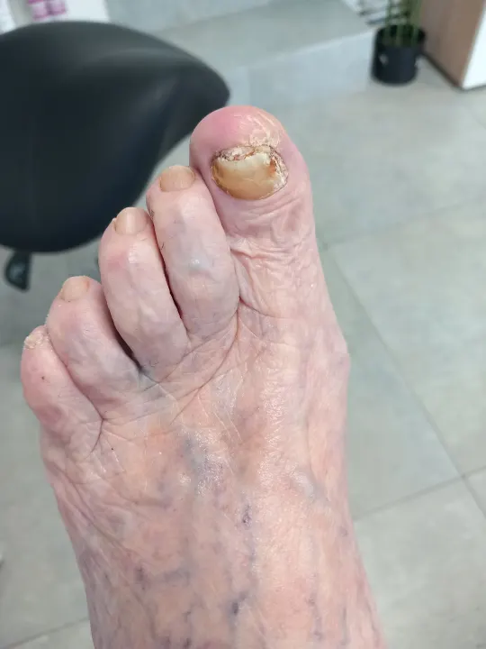 Zhrubnutý necht palca s uvoľnenou platničkou