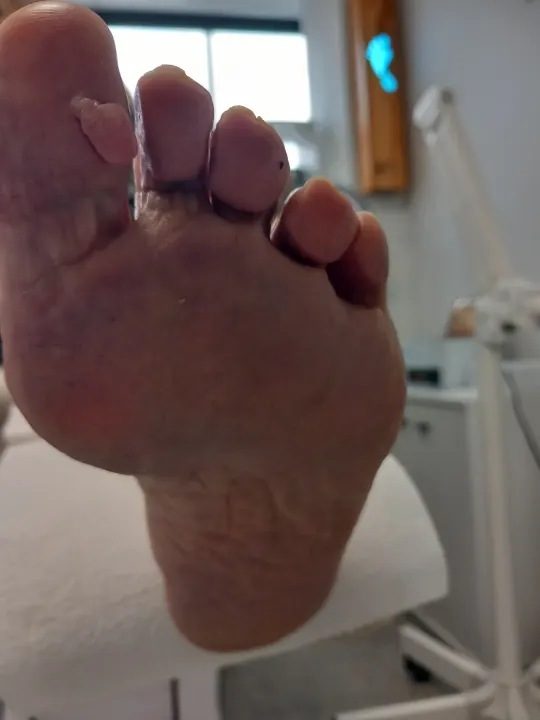 Zhrubnutý necht palca s uvoľnenou platničkou