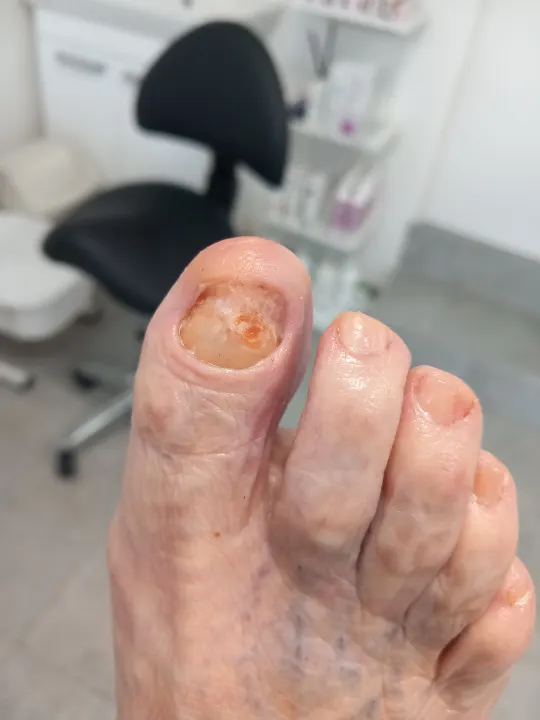 Zhrubnutý necht palca s uvoľnenou platničkou