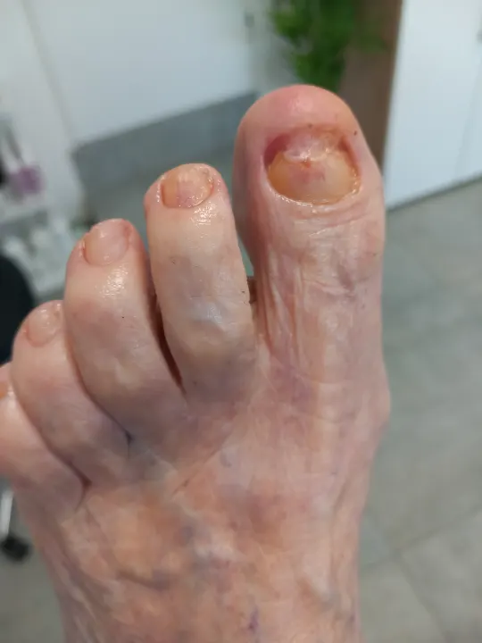Zhrubnutý necht palca s uvoľnenou platničkou