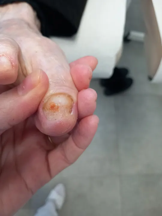 Zhrubnutý necht palca s uvoľnenou platničkou