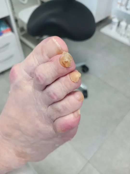 Zhrubnuté nechty a tvrdá koža na päte