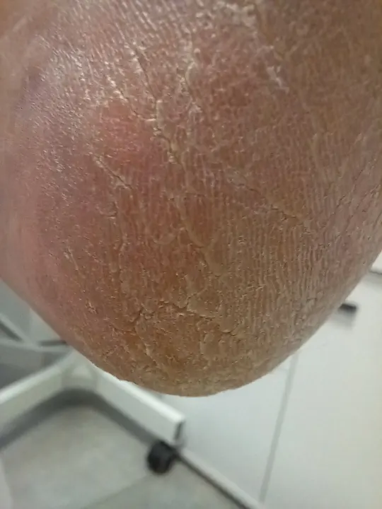Hrubá vrstva kože na päte odstránená krok za krokom