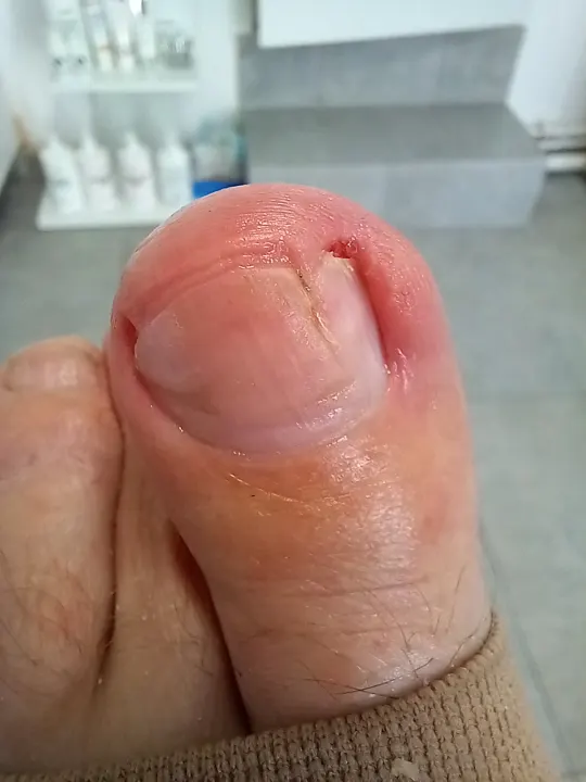 Keď aj malý okraj nechtu dokáže bolieť