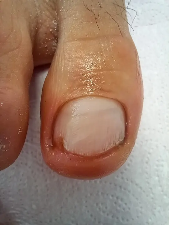 Keď aj malý okraj nechtu dokáže bolieť
