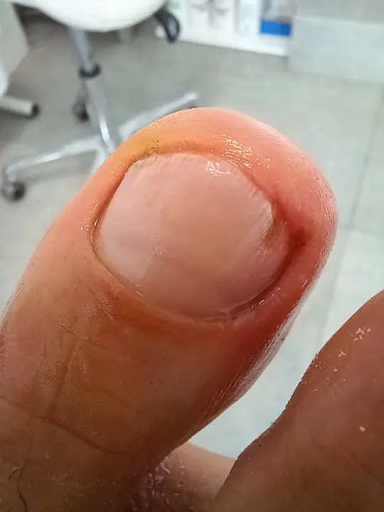Keď aj malý okraj nechtu dokáže bolieť