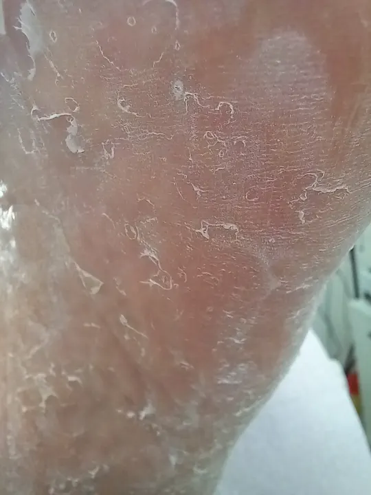 Olupujúca sa koža na celom chodidle