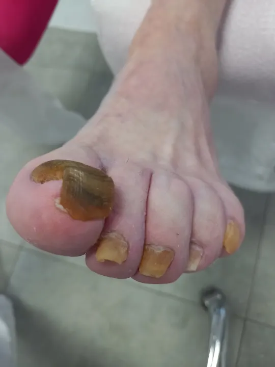 Prerastené nechty, ktoré už menili smer rastu
