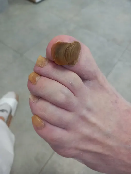 Prerastené nechty, ktoré už menili smer rastu