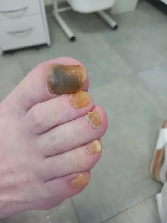 Prerastené nechty, ktoré už menili smer rastu