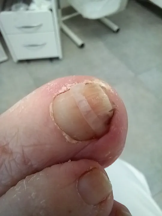 Oddelený necht a citlivé lôžko pod ním