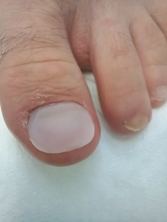 Poškodený necht dostal späť prirodzený tvar