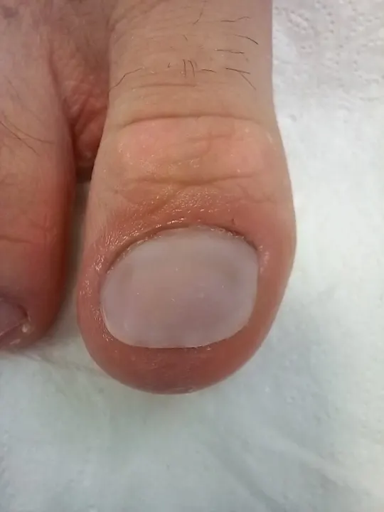 Poškodený necht dostal späť prirodzený tvar