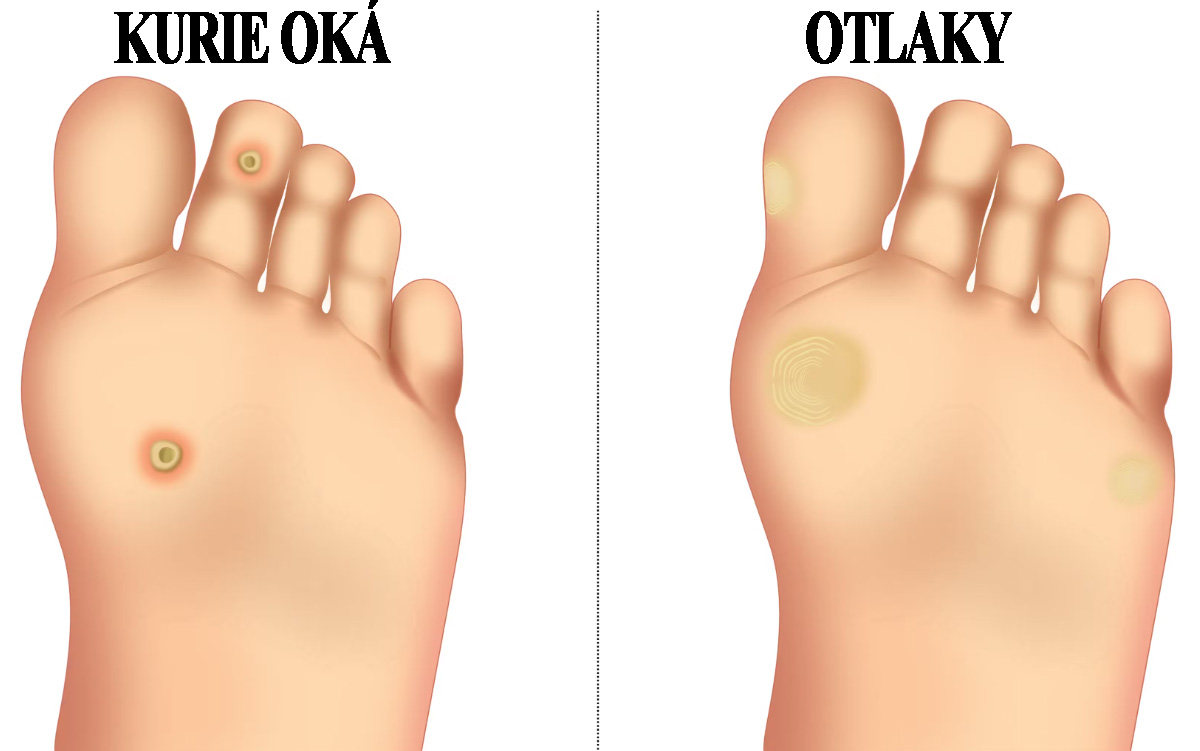 Korie oká a odtalky