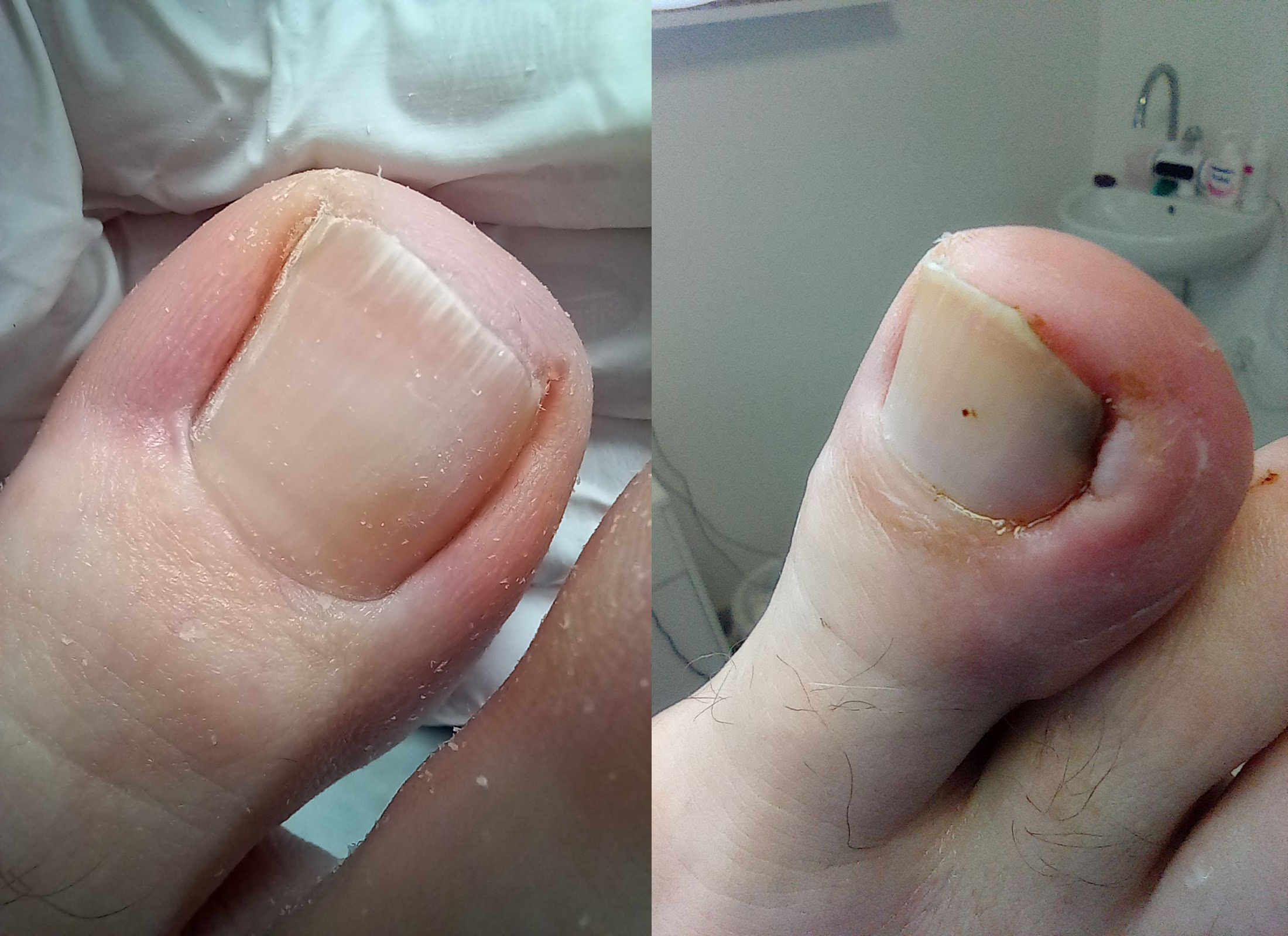 Ošetrenie zarastajúcich nechtov